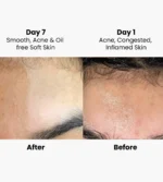 before and after results of gleebellus acne serum for congestion and oily skin