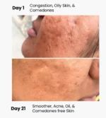 before and after acne 21 days